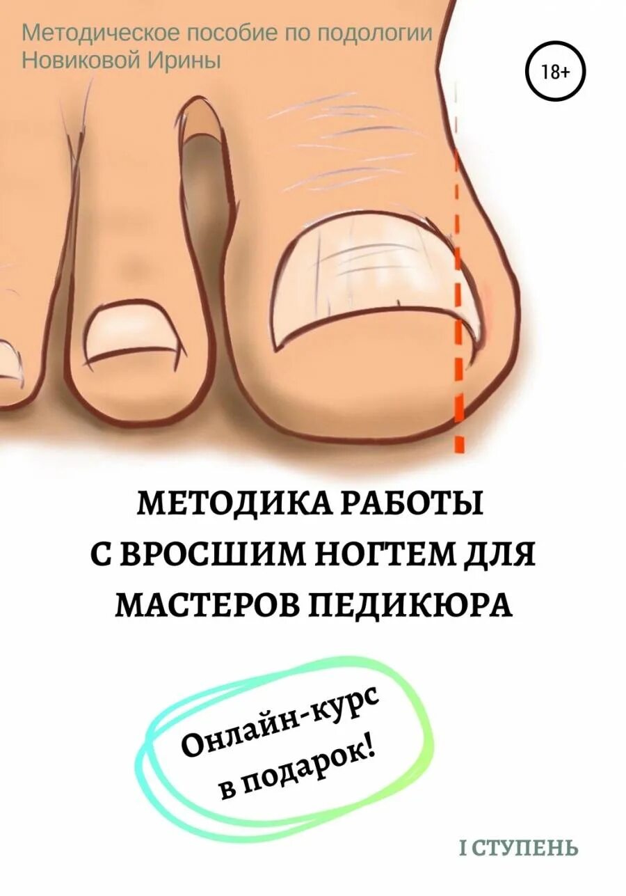 Как правильно стричь вросший ноготь. Вровросший ноготь на ноге. обработка вросшего ногтя.