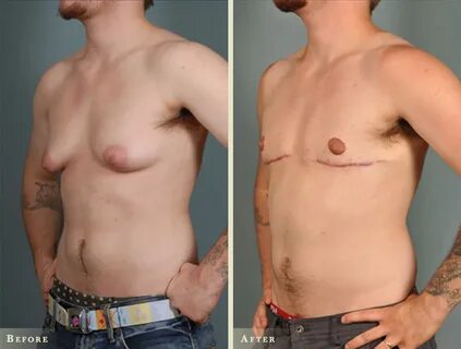 breast removal - feliciahotelandsuits.com.