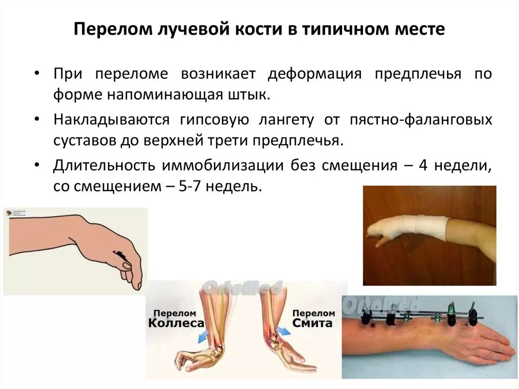 Резкий крутой перелом в чем нибудь. Иммобилизация при переломе лучевой кости. Деформация при передома лучевой кости в типичном месте. Перелом луча в типичном месте транспортная иммобилизация. Сроки иммобилизации при переломе лучевой кости в типичном месте.