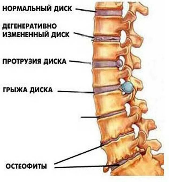 Начальная дегенеративно дистрофические изменения поясничного отдела. Дегенеративные изменения позвоночника. Дистрофические изменения позвоночника. Дегенеративные изменения грудного отдела позвоночника что это такое. Дегенеративно-дистрофические изменения шейного отдела позвоночника.