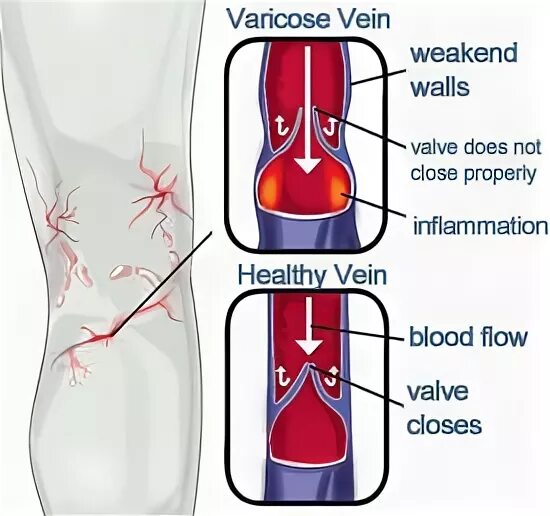 Эндовенозная лазерная коагуляция вен. Close properly. Stop varicose veins need help everyone in home. Safety topic. Close properly.