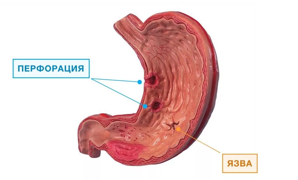 Язвенная болезнь желудка перфорация. Прободение язвы желудка. Перфоративная язвенная болезнь желудка. Пенетрация язвы желудка. Перфорация язвы симптомы