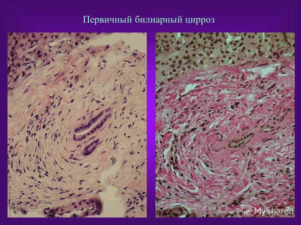 Протоковые изменения в печени. Первичный билиарный цирроз печени гистология. Билиарный цирроз гистология. Билиарный цирроз печени гистология. Портальный цирроз макропрепарат.