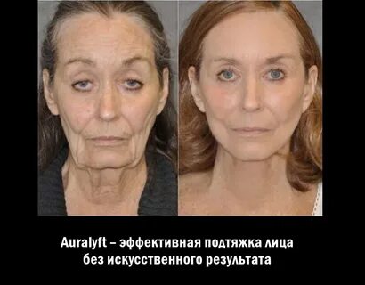 Диспорт в нижнем