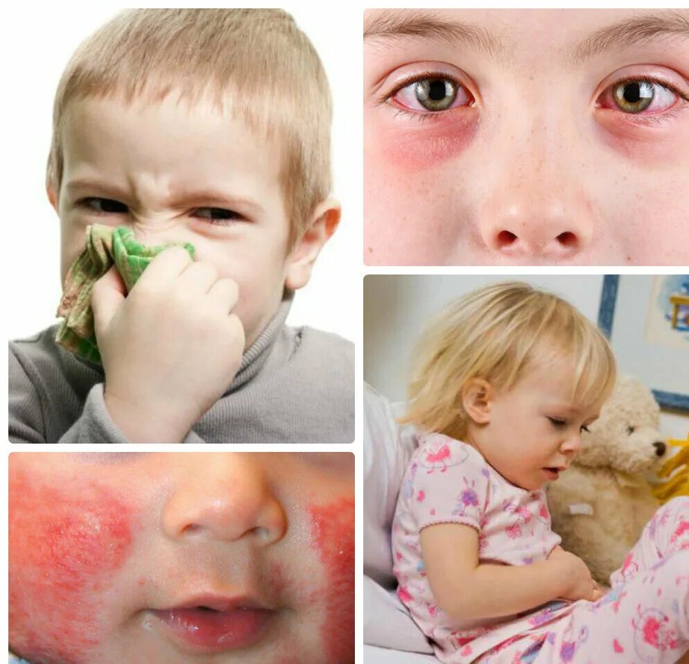 Пищевая аллергия у грудничка. Пищевая аллеггияу детей. Пищевая аллергия признаки. 3 пищевая аллергия у детей. Пищевая аллеггияу детей.