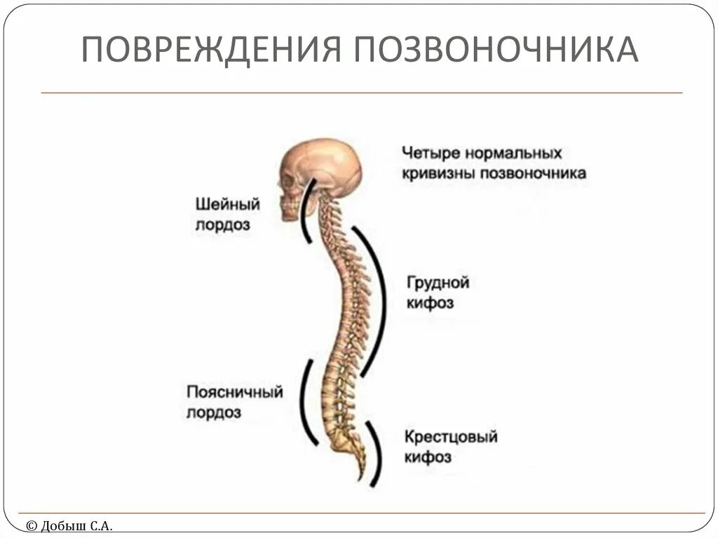 Строение позвоночника лордоз кифоз. S образный изгиб позвоночника кифоз лордоз. Лордоз грудного отдела позвоночника. С образный изгиб позвоночника. Изгиб позвоночника в сторону называется