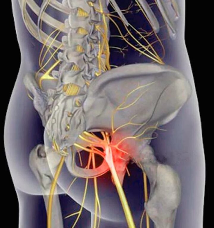 Боль в пояснице защемление седалищного. Люмбоишиалгия седалищного нерва. Остеохондроз люмбоишиалгия. Вертеброгенная люмбоишиалгия позвоночника.