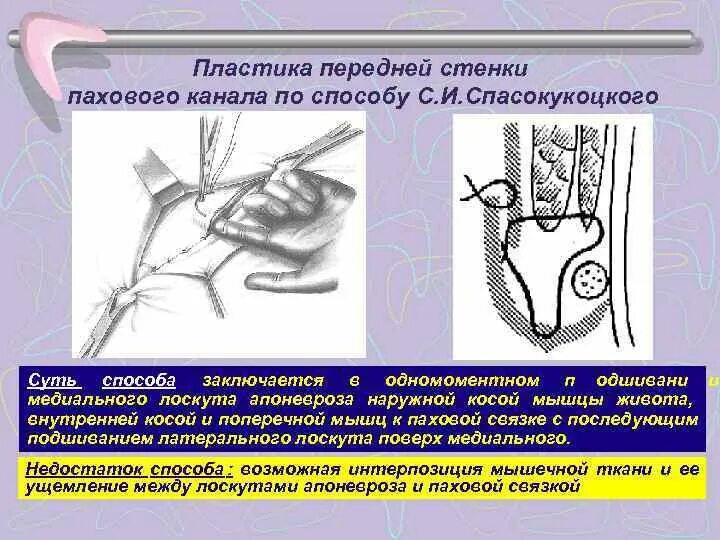 Операция по Жирару Спасокукоцкому при паховой грыже. Пластика косой паховой грыжи по Жирару-Спасокукоцкому. Операция Жирара Спасокукоцкого. Пластика паховой грыжи по Жирару-Спасокукоцкому.