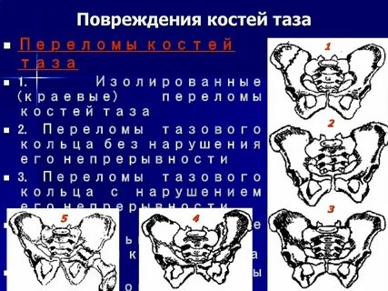 Повреждение таза и тазовых органов