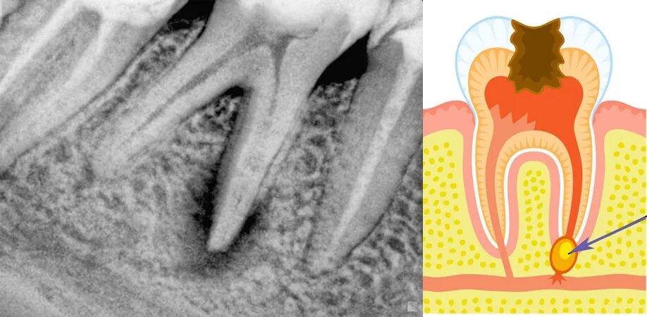 острый пульпит диагноз