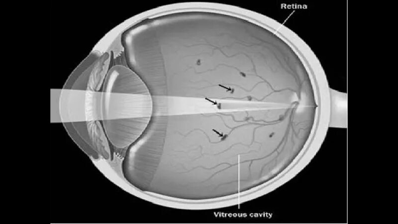 Нитчатая деструкция стекловидного. Витреолизис стекловидного тела. Деструкция витреолизис. Деструкция стекловидного тела глаза. Прозрачное тело в глазу