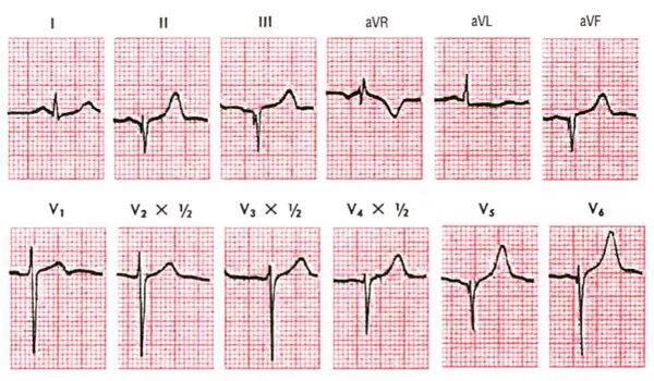 Изменение зубца q. Патологический зубец q в отведениях v1-v3. Патологический зубец q в v1 v2 v3. Патологический зубец QS на ЭКГ. V1-3 патологический зубец q.