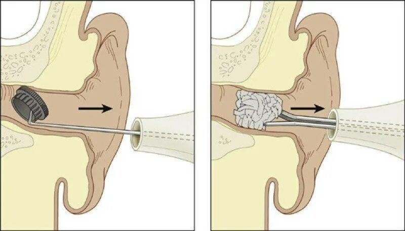 Сними трубочку. Инородное тело в узехе. Посторонние предметы в ухе.