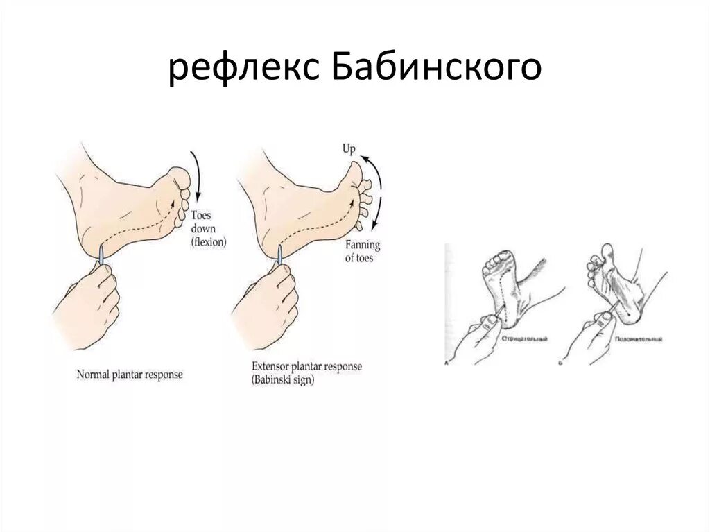 Рефлекс живого. Рефлекс Бабинского. Разгибательный рефлекс Бабинского. Патологические рефлексы симптом Бабинского. Пирамидный симптом Бабинского.