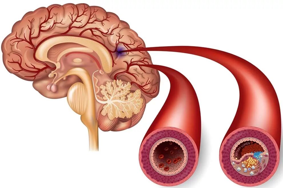 Атеросклероз церебральных сосудов симптомы. Атеросклероз артерий головного мозга. Атеросклероз церебральных сосудов. Атеросклероз сосудов мозга.
