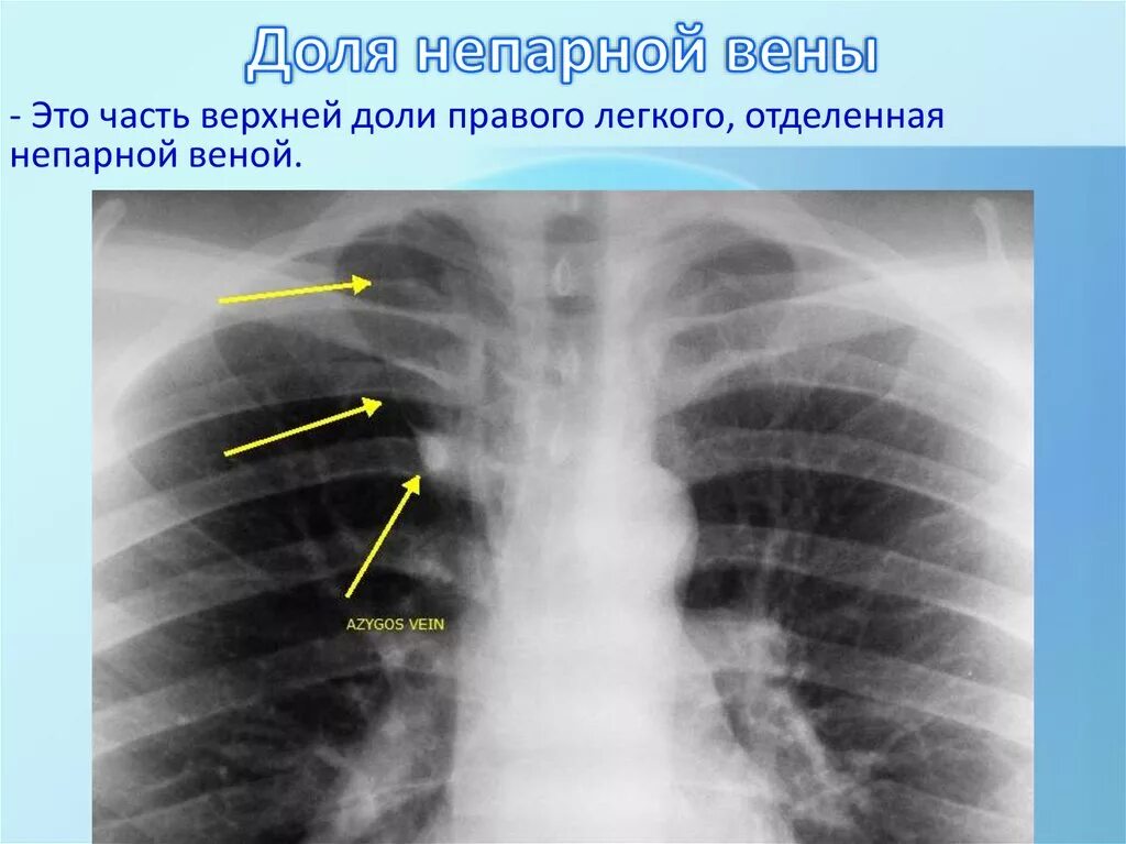 Тень в верхней доле. Вена азигос рентген. Добавочная Вена азигос. Вена azygos на рентгенограмме.