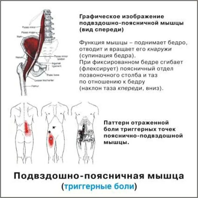 Подвздошно-поясничная мышца триггерные точки. Подвздошно-поясничная мышца триггерные боли. Подвздошно поясничная мышца живота функции. Укорочение подвздошно-поясничной мышцы одностороннее. Слабая поясница