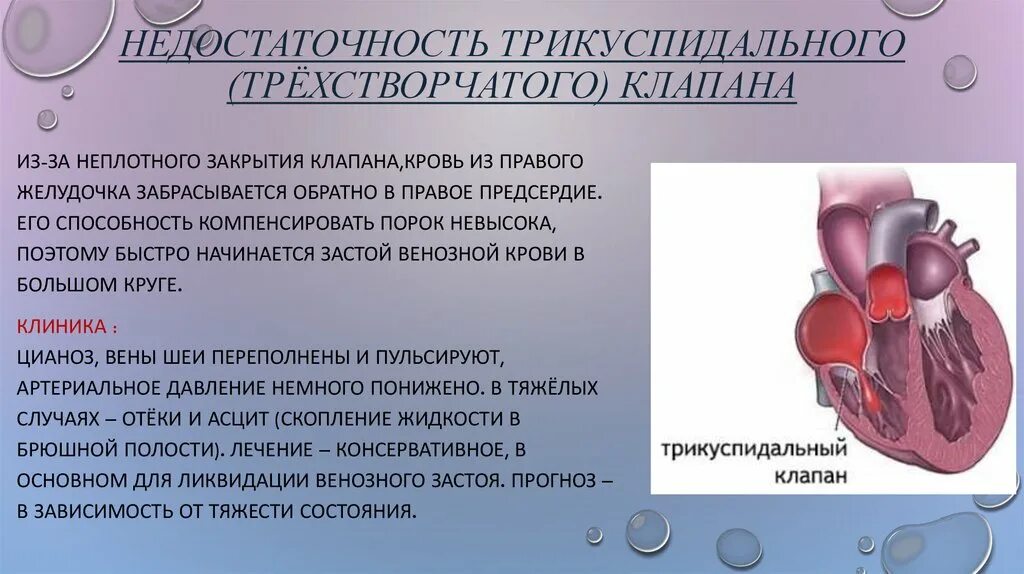 Недостаточность трехстворчатого клапана 2 ст. Недостаточность трехстворчатого клапана 2 степени. Недостаточность и стеноз трехстворчатого клапана. Порок трикуспидального клапана сердца.