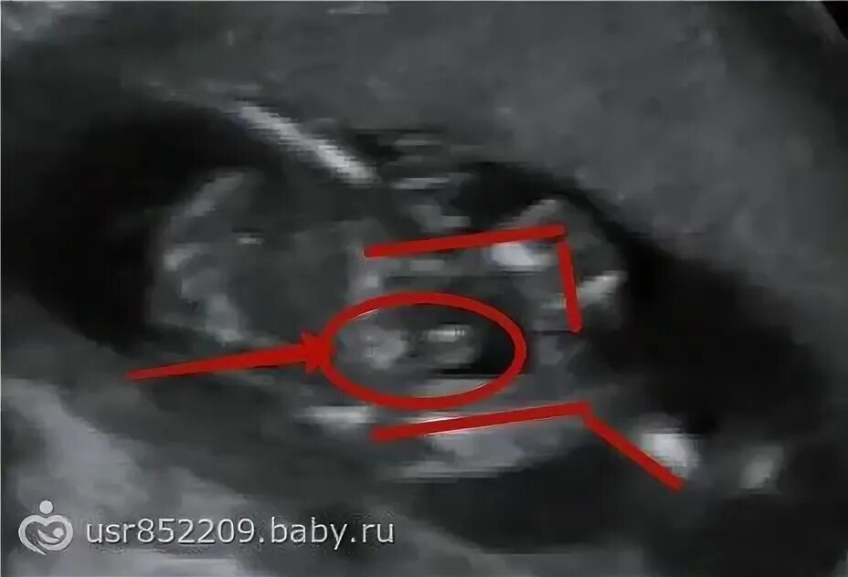 Узи ошиблось с полом форум. Пол мальчика на узи. узи половых органов девочки.