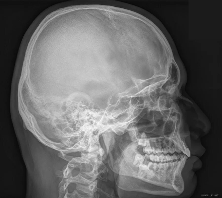 Сотрясение черепа. Рентген черепа сотрясение мозга. Остеосклероз черепа рентген. Перелом свода черепа рентген. Пахионовы грануляции рентген черепа.