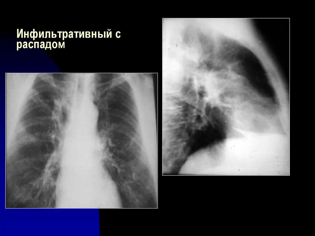 Инфильтративный туберкулез в фазе инфильтрации. Инфильтративный туберкулез с распадом. Инфильтративный туберкулез фаза обсеменения. Инфильтративный распад легких