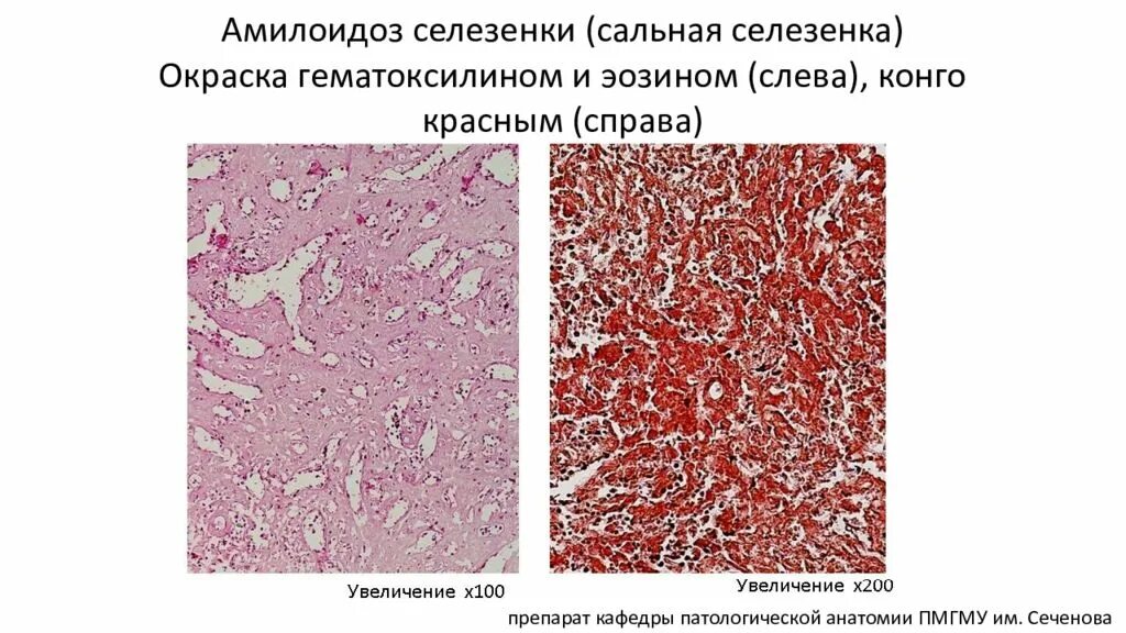 Амилоидоз препарат. Амилоидоз почек гистология. амилоидоз селезенки микропрепарат. амилоидоз почки макропрепарат.