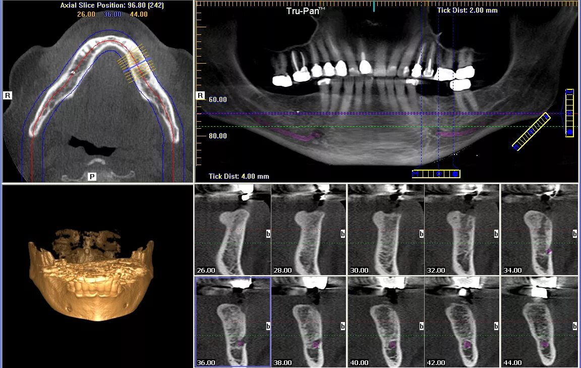 Имплант и мрт можно ли. Компьютерная томография 2 челюсти. Компьютерная томография челюсти 3d. Дентальная компьютерная 3d томография схема. Кт 3д зубочелюстной системы.