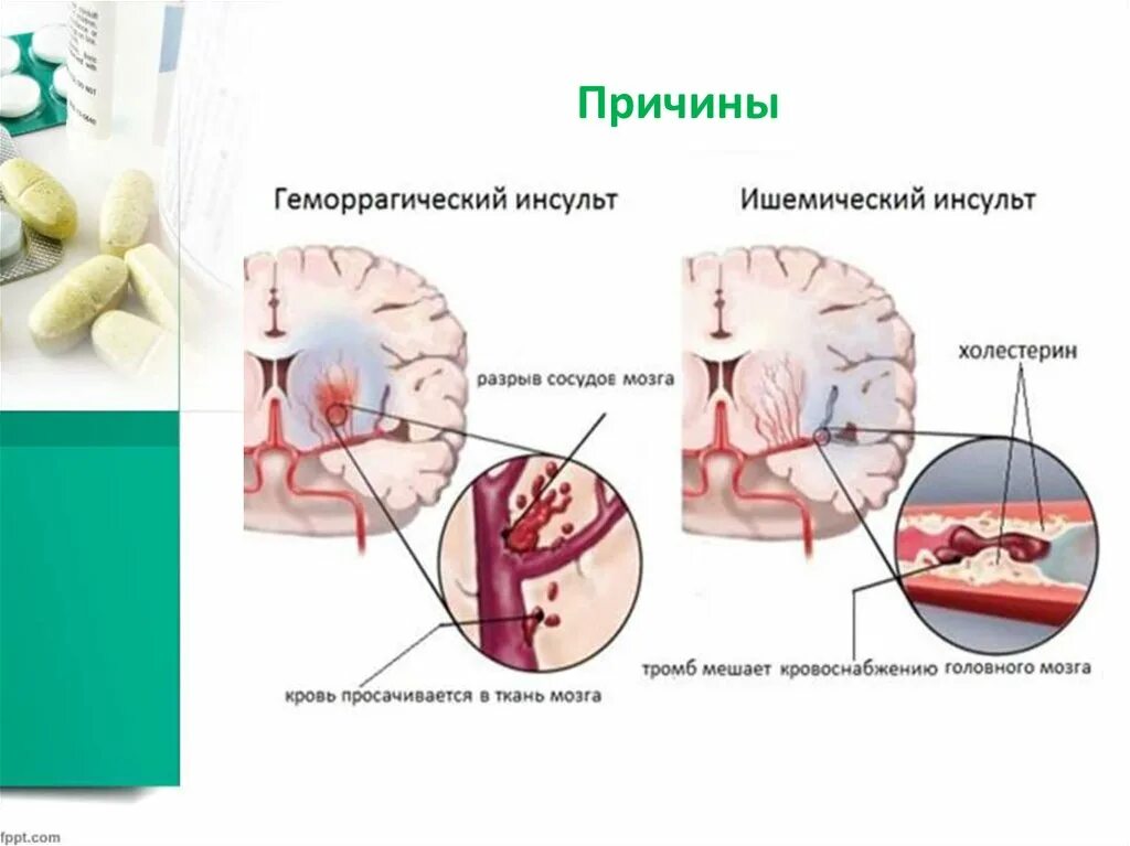 Геморрагический инсульт причины. Клиника геморрагического инсульта симптомы. Клиника ишемического и геморрагического инсульта. Геморрагический инсульт и ишемический инсульт. Был геморрагический инсульт