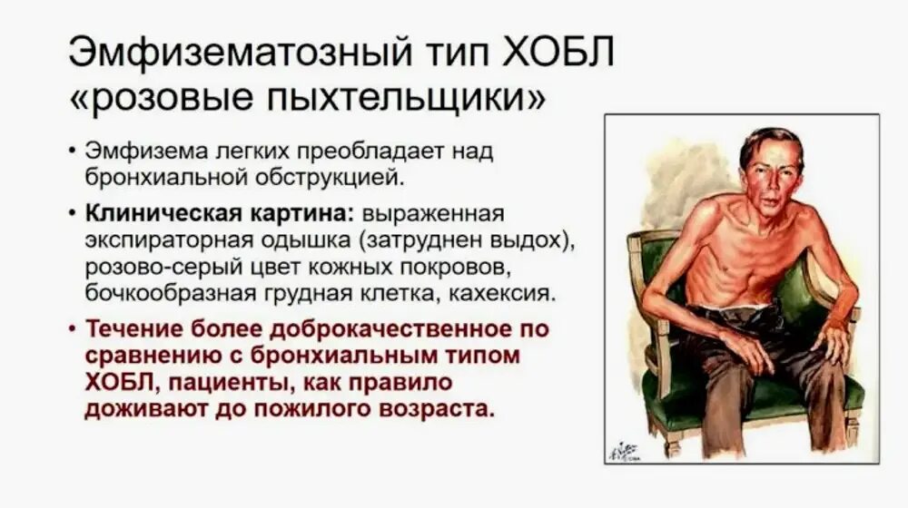 Положение при хобл. Эмфизематозный тип больного хобл. эмфизематозный тип при хобл. основные клинические симптомы хобл. клиническая картина обострения хобл.