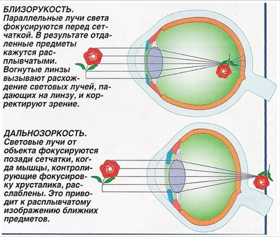 Анатомия глаза близорукость и дальнозоркость. Строение глаза человека близорукость. Глаз дальнозоркость и близорукость. Зрение близорукость и дальнозоркость. Какое зрение при дальнозоркости
