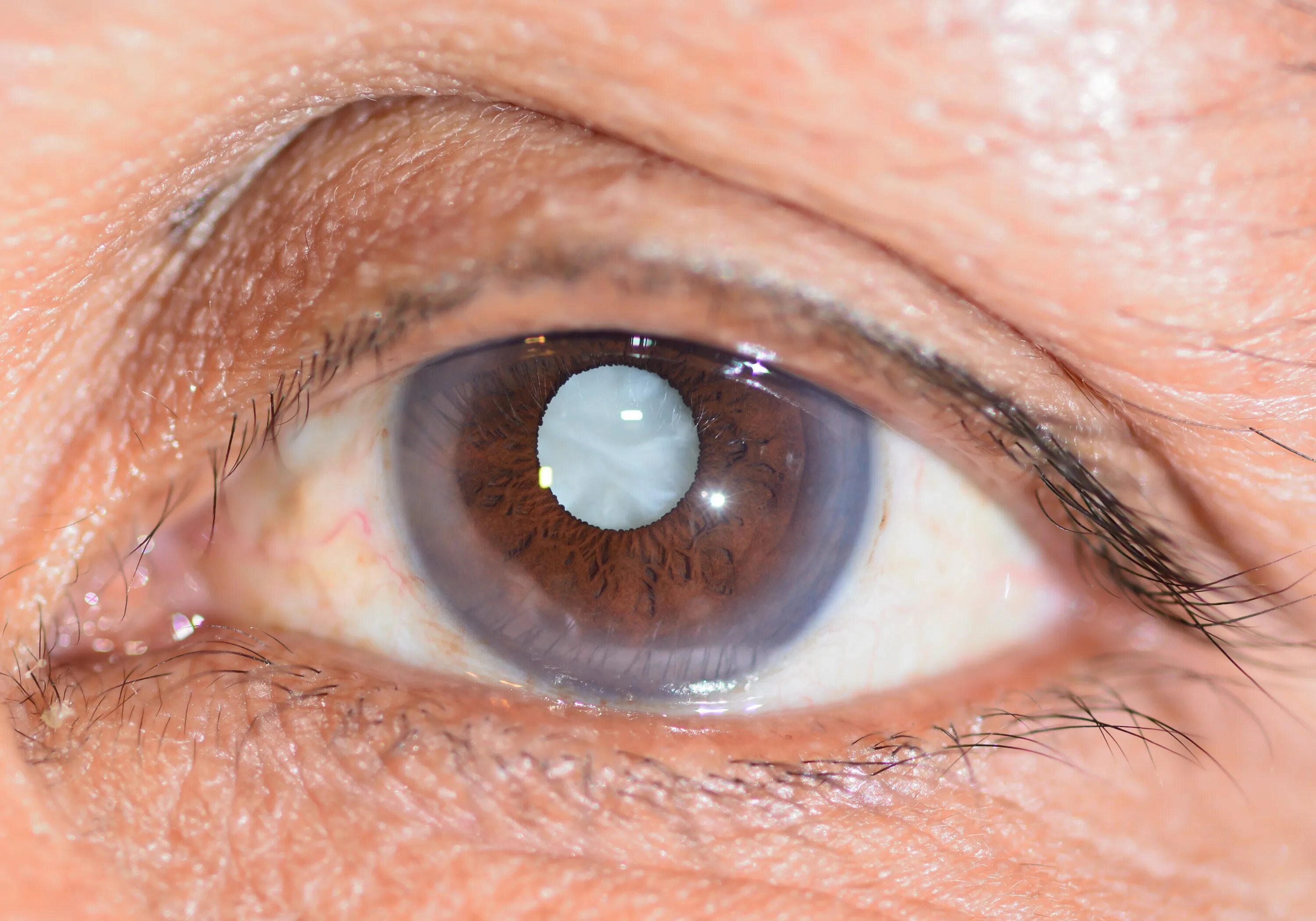 Эффективное лечение катаракты. Кольцевидная катаракта Фоссиуса. Гипокальциемическая катаракта. Сенильная катаракта глаза. Дистрофия роговицы с катарактой.