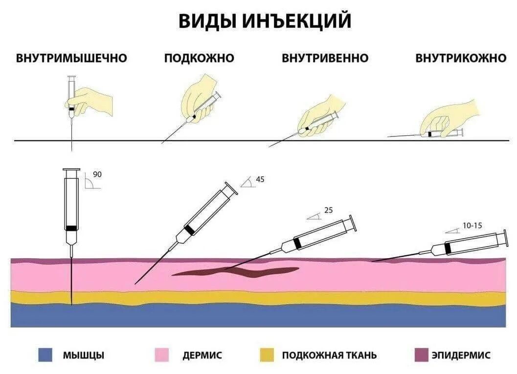 Угол введения внутривенной инъекции. Внутривенная инъекция глубина введения иглы. Углы введения иглы при инъекции. Угол введения иглы при внутривенной инъекции.