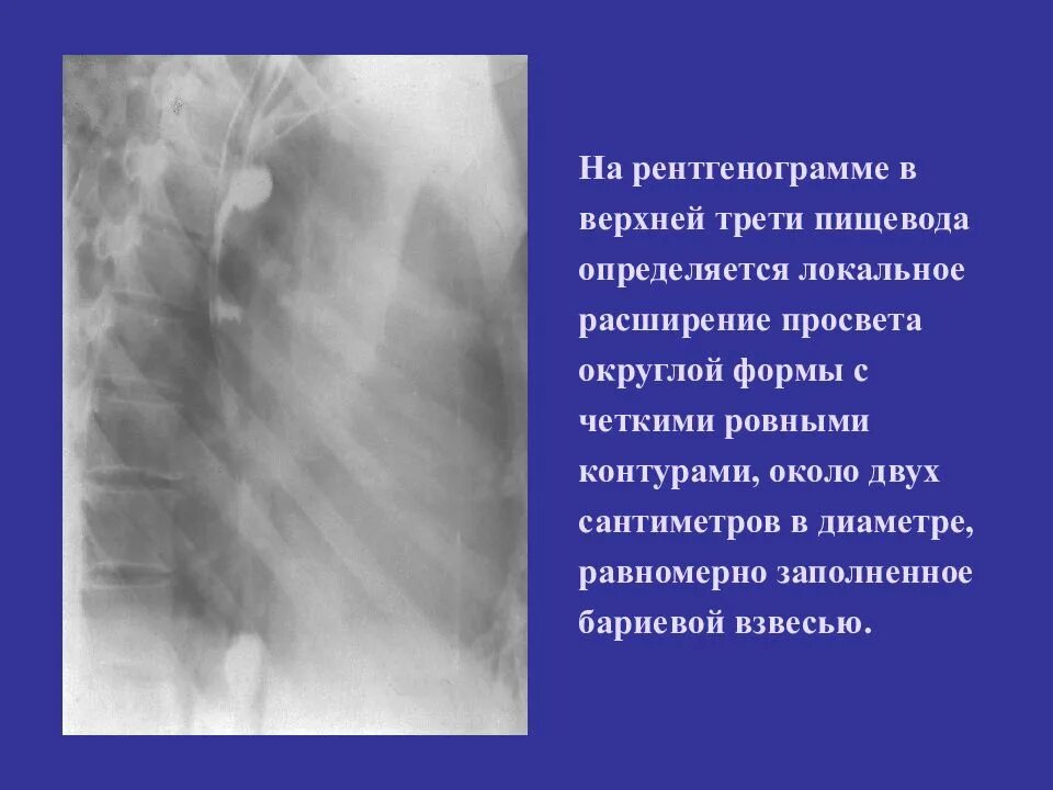 Просвет пищевода. Расширение просвета пищевода. Локальное расширение просвета пищевода. Расширен просвет пищевода верхней трети.