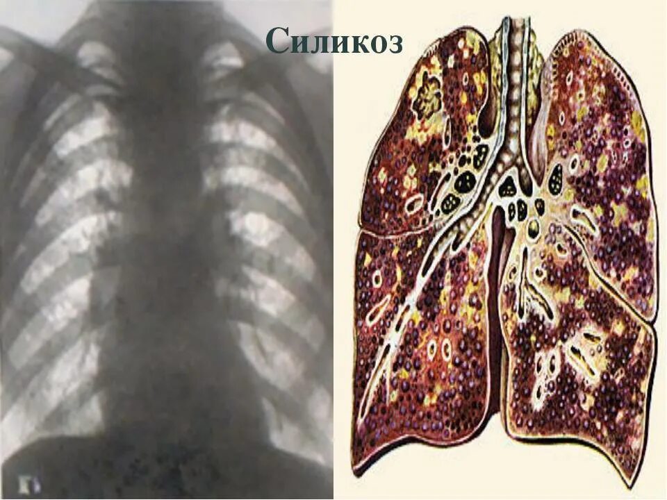 Легкие после поражения. Болезнь легких силикоз.