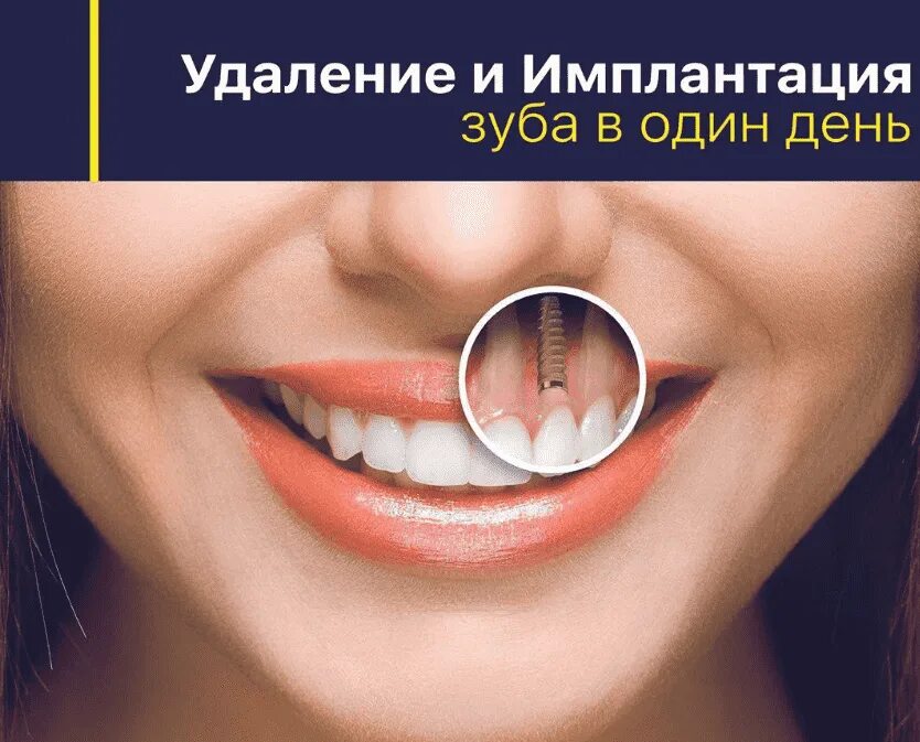 Можно ли поставить зуб после удаления. Имплантация зубов в зоне улыбки. швы после имплантации зубов. имплантация после удаления зуба.