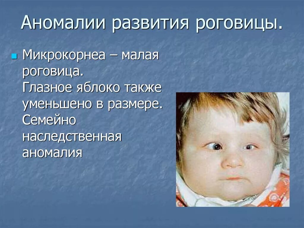 Аномалии развития называются. Аномилии развития Рогов. Аномалии развития роговицы. Врожденные пороки развития.