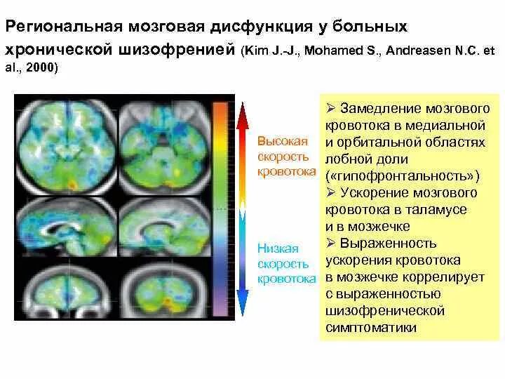 Шизофрения изменения в мозге. Дисфункция головного мозга. Снимок мрт при шизофрении. Функциональное нарушение мозга