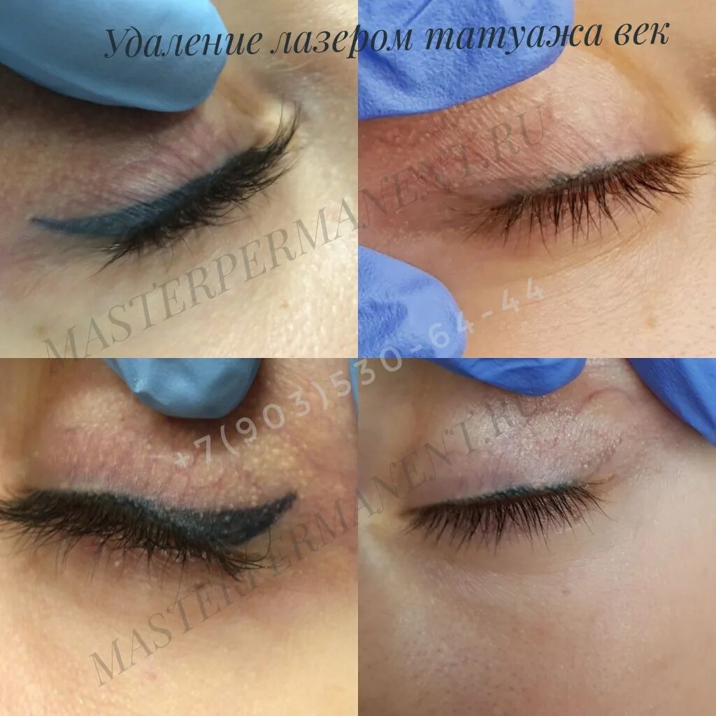 Ремувер для снятия татуажа стрелок. Удалить глаз татуаж. Удалённый перманентный макияж век. Удалить глаз татуаж. Удалить глаз татуаж.