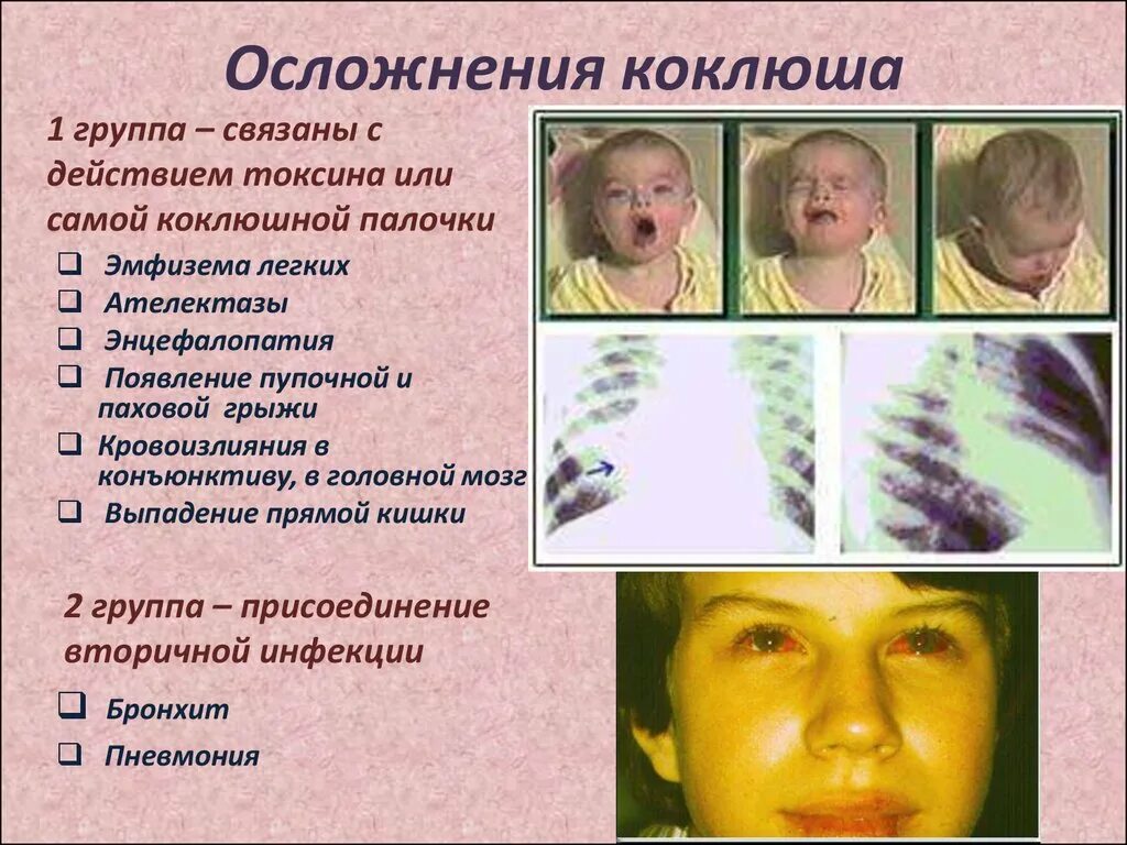 Температура при коклюше у детей сколько держится. Характерные клинические симптомы коклюша. болезнь коклюш симптомы. специфический симптом при коклюше. коклюш кашель у детей симптомы.