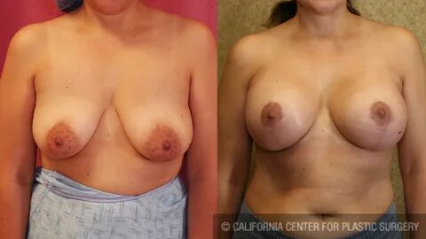 Full Breast Lift Before & After Patient #6925.