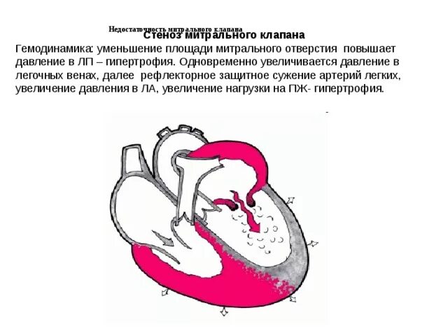 Схемы изменений гемодинамики при митральном стенозе. Стеноз митрального клапана гемодинамика схема. Митральный стеноз изменения гемодинамики. Стеноз митрального клапана нарушение гемодинамики.