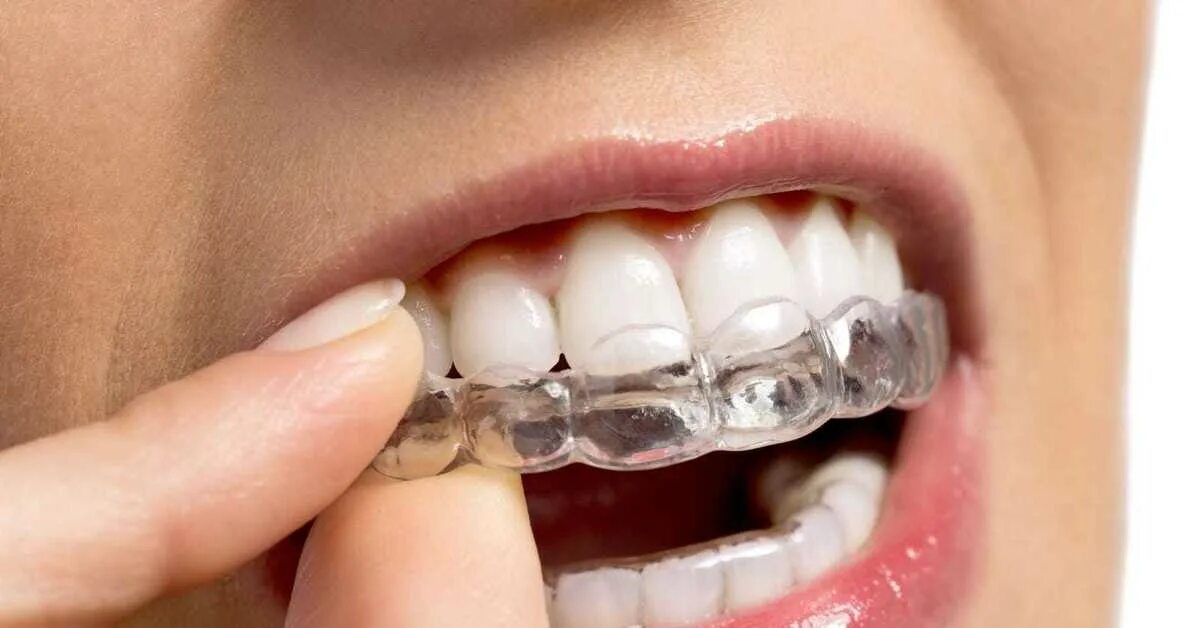 Материалы каппы. Каппы инвизилайн. элайнеры invisalign. элайнеры инвизилайн. ортодонтическая капа элайнеры.