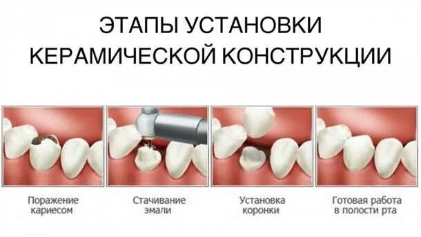 Как снять зубную коронку в домашних условиях чем приклеить дома зубную коронку (100) фото
