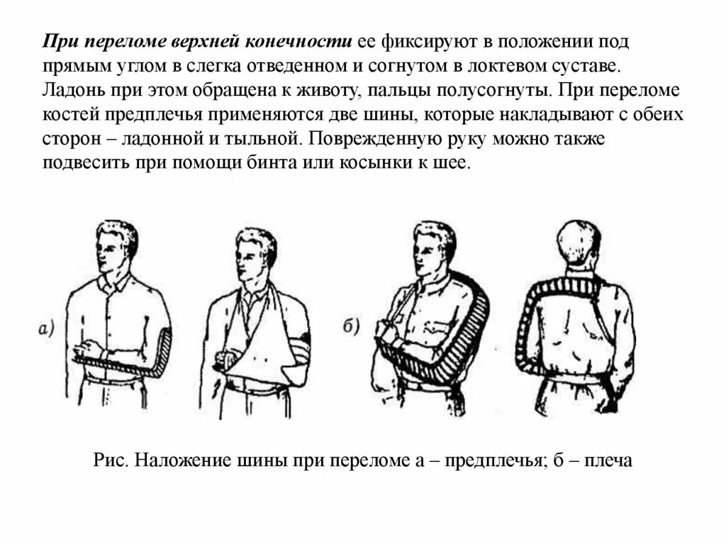 1 помощь при переломе верхней конечности. При переломе плечевой кости шиной фиксируют. При переломе плечевой кости шина должна фиксировать:. При переломе плечевой кости необходимо фиксировать суставы. При переломе плечевой кости кости фиксируют.