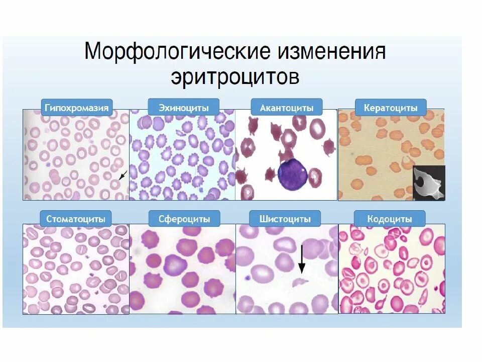 Формы встречающихся эритроцитов. Патологические формы эритроциты крови. морфологические изменения эритроцитов. морфологические формы эритроцитов. патологические изменения эритроцитов.