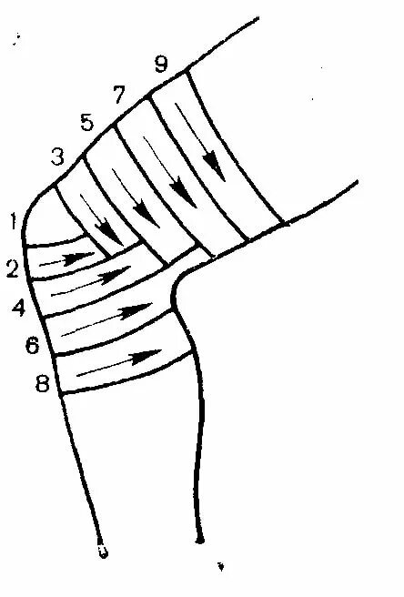 Черепашья сходящаяся перевязка на колено. Черепашья сходящаяся на коленный сустав повязка. Черепашья сходящаяся повязка на коленный алгоритм. Черепашья бинтовая повязка. Как перевязывать колено