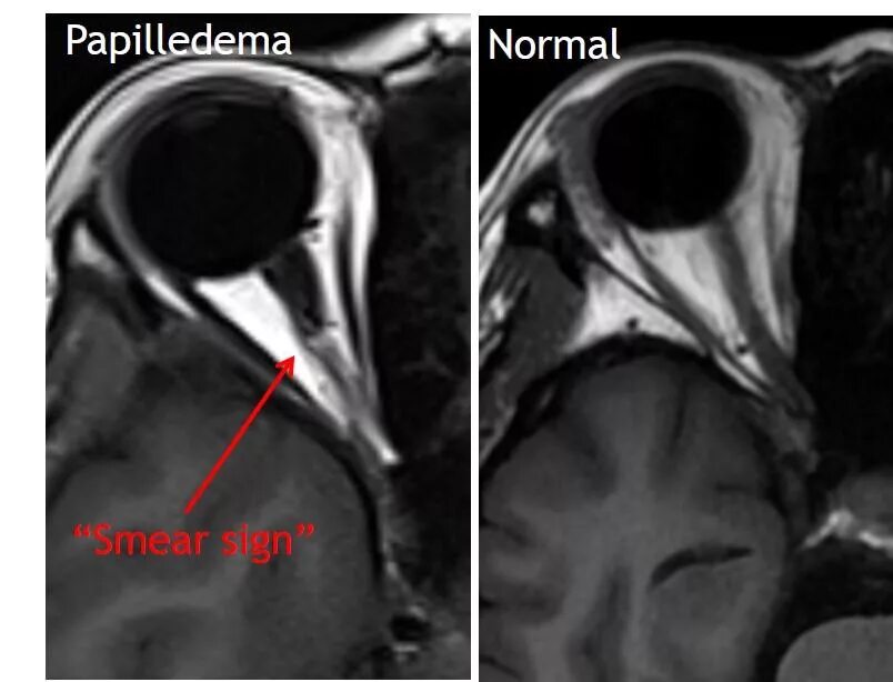 Расширение зрительного нерва. Неврит зрительного нерва (воспаление зрительного нерва). Ретробульбарный неврит зрительного нерва офтальмология. Расширение зрительного нерва. Атрофия зрительного нерва симптомы.