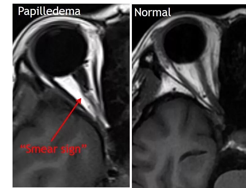 Мрт глазного нерва. Отек диска зрительного нерва мрт. Атрофия зрительного нерва мрт. Неврит зрительного нерва мрт. Менингиома зрительного нерва мрт.