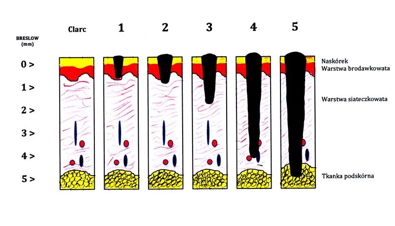 Классификация Бреслоу Кларка меланом. Уровни инвазии меланомы по Кларку. Инвазия меланомы по Кларку и Бреслоу. Классификация меланомы по Бреслоу. Степень инвазии