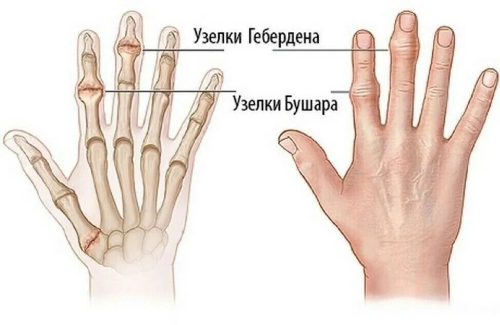Как выглядит сустав пальца
